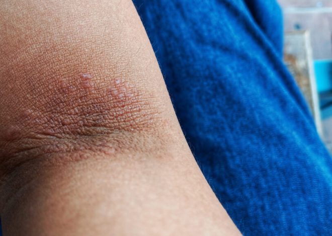 Eczema drug Kymera succeeds in first trial, could rival Dupixent