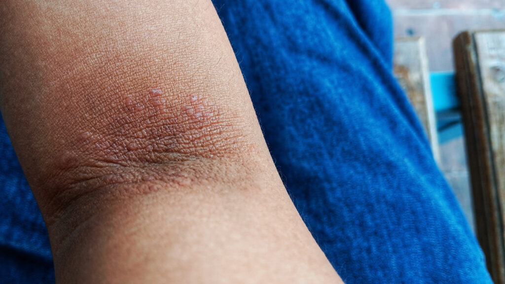 Eczema drug Kymera succeeds in first trial, could rival Dupixent