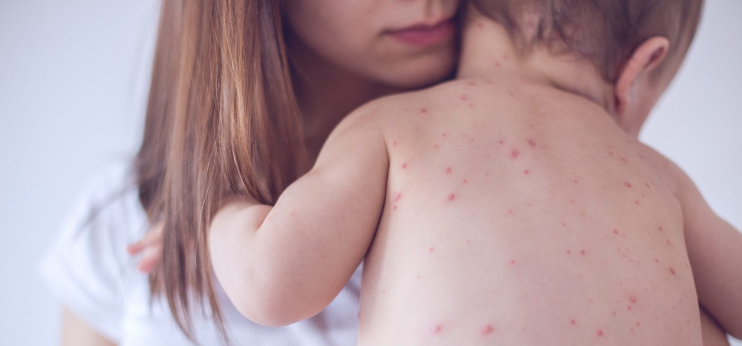 Can you get chickenpox twice? 13 big animal pox researches this week