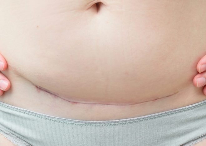 Cesarean scar endometriosis – yes, it’s a thing
