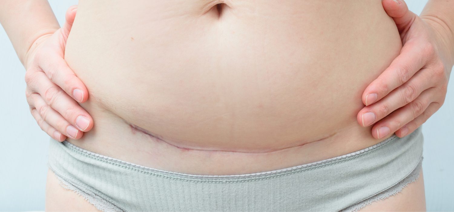 Cesarean scar endometriosis – yes, it’s a thing
