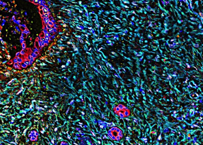 Expert analyzes potential new breakthrough in pancreatic cancer