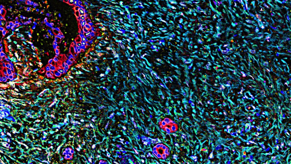 Expert analyzes potential new breakthrough in pancreatic cancer