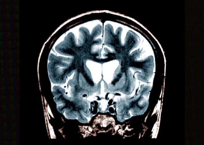 Biotech raises $42 million to run Huntington’s disease trial