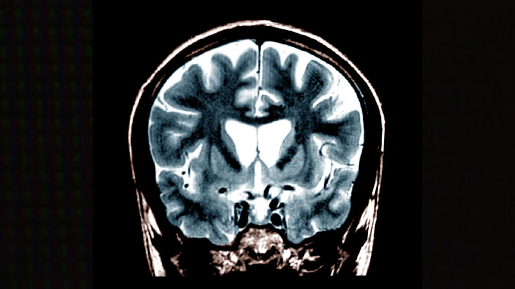 Biotech raises $42 million to run Huntington’s disease trial
